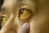 Nếu mắt có 6 thứ, đi khám ung thư ngay còn kịp!