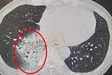 Người phụ nữ phổi trắng xóa vì kiểu dùng điều hòa hiếm gia đình Việt nào chưa từng mắc