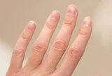 Kiểm tra móng tay ngay xem có dấu hiệu này không - nếu có phải đi khám!