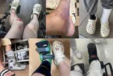 Lời khuyên cho những người thích đi dép sục, dép "kiểu crocs"