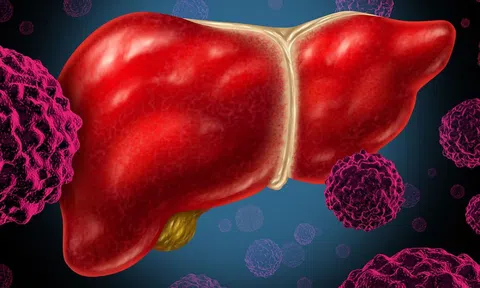 Phát hiện 'thủ phạm' âm thầm 'nuôi' tế bào ung thư trong gan: Không phải rượu bia hay thuốc lá