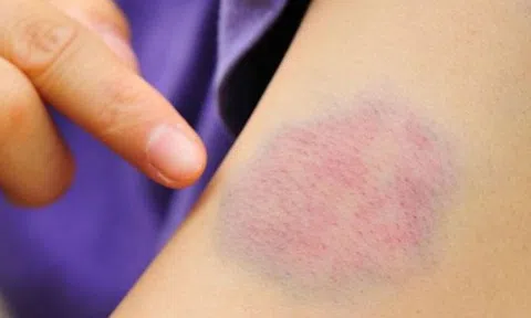 5 dấu hiệu nhỏ trên da "tố cáo" bệnh gan, nhiều người dễ xem thường