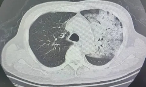 Người đàn ông sốt 40 độ C, phổi gần như 'trắng xóa", chỉ vài ngày đã suy đa tạng: Thủ phạm liên quan đến thói quen nhiều gia đình vẫn mắc