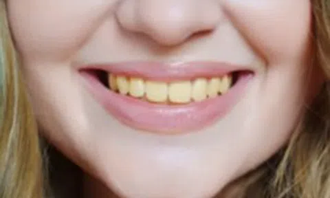 Chuyên gia chỉ ra 4 thực phẩm làm răng ố vàng, đánh mãi vẫn không trắng