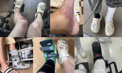 Lời khuyên cho những người thích đi dép sục, dép "kiểu crocs"