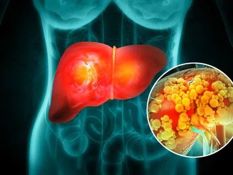 Không phải thịt mỡ, đây mới là "kẻ thù" số 1 của gan: Hóa ra là thứ vạn người mê mẩn