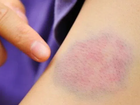 5 dấu hiệu nhỏ trên da "tố cáo" bệnh gan, nhiều người dễ xem thường