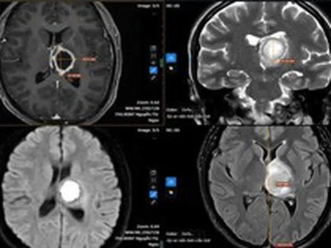 Thường xuyên buồn ngủ, đi khám “sốc” nặng khi biết nguyên nhân