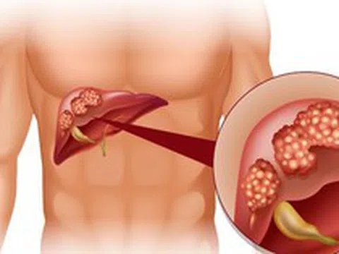 Cảnh báo từ WHO: 1 loại ĐỘC TỐ gây ung thư ẩn trong nhiều thực phẩm quen thuộc mà người Việt ĂN MỖI NGÀY
