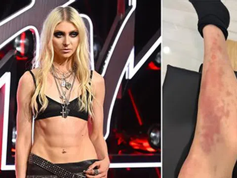 Nữ ca sĩ 33 tuổi nhập viện cấp cứu vì bị nhện độc cắn