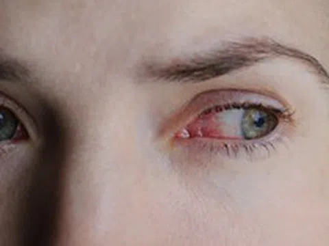 Chàng trai 24 tuổi mù đột ngột: Bác sĩ cảnh báo về thói quen mà nhiều người trẻ đang mắc mỗi tuần