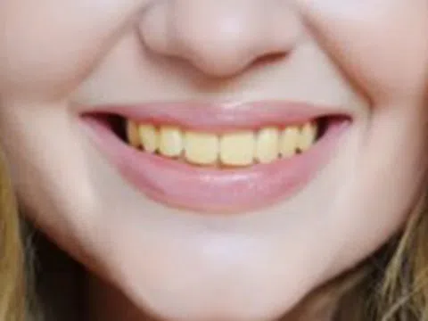 Chuyên gia chỉ ra 4 thực phẩm làm răng ố vàng, đánh mãi vẫn không trắng