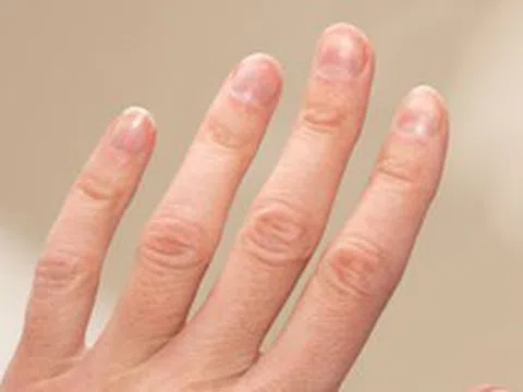 Kiểm tra móng tay ngay xem có dấu hiệu này không - nếu có phải đi khám!